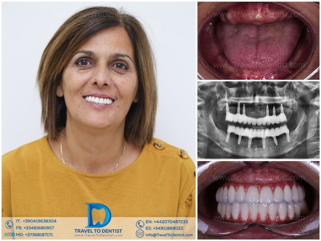 Caso clínico 5 — Prótesis dental